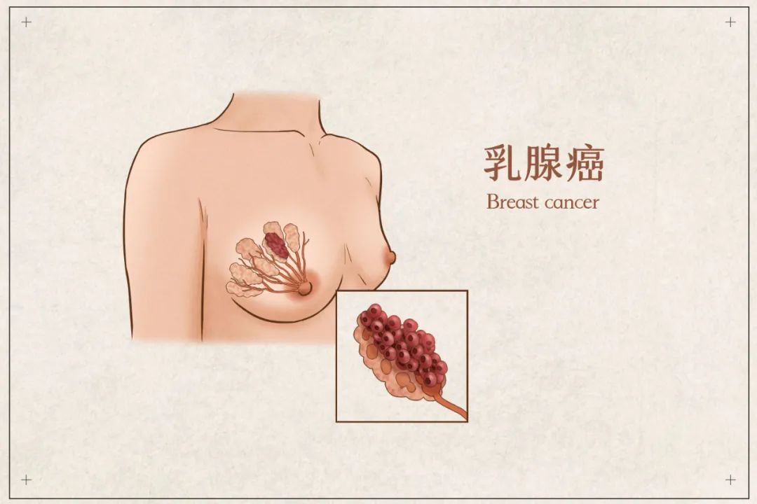 30岁做了钼靶好后悔啊_做钼靶后悔了_建议做钼靶是不是很严重